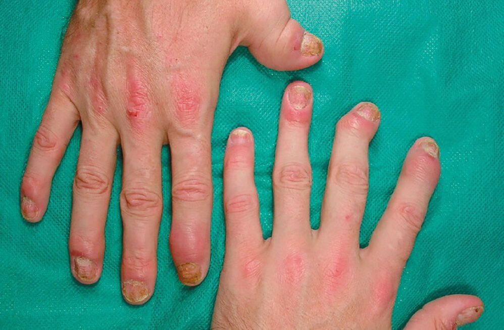 allergie met parasieten in het lichaam