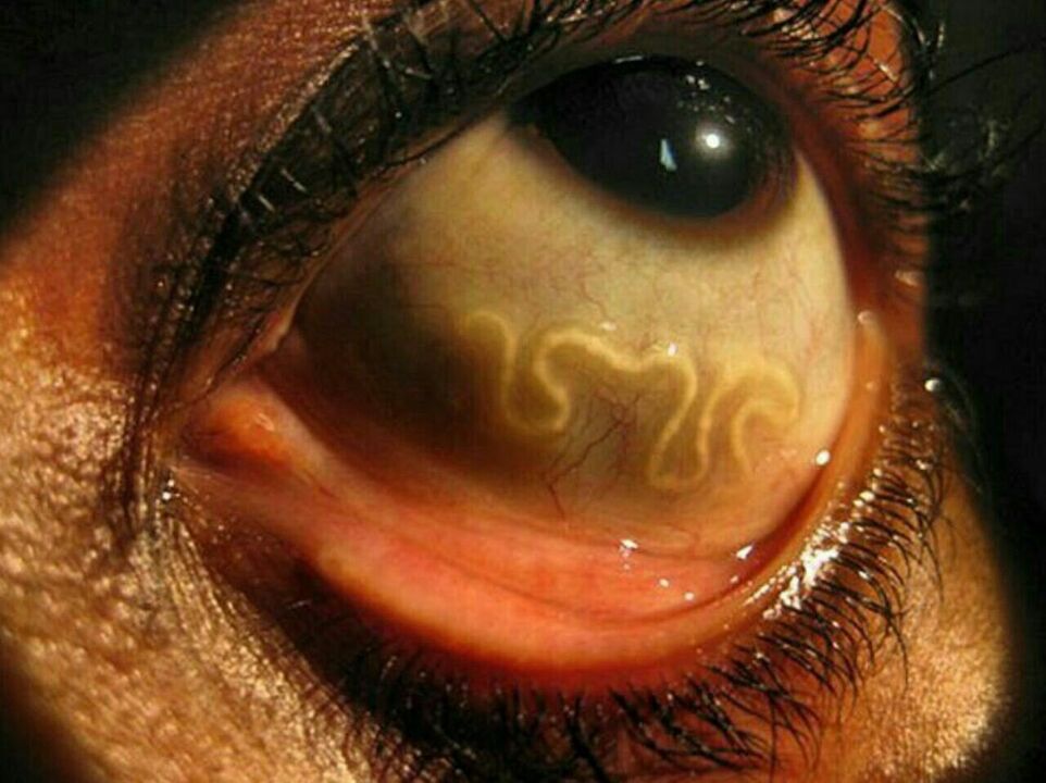 parasieten in het menselijk oog